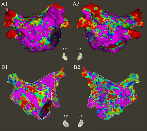 Figure 1 Left atrial (LA) voltage mapping from 2 patients. The area of voltage <0.5 mV was used to define scar tissue (<0.5 mV – red, green, and blue on the map) and normal tissue (>0.5 mV – purple on the map). A1 and B1 were in the anteroposterior (AP) projection. A2 and B2 were in the posteroanterior (PA) projection. Patient 1 (A1-A2) had better substrate in LA, and the LVA (30.6%) was limited. Patient 2 (B1-B2) had widespread LVA (79.2%).