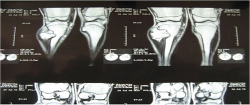 Figure 4 Magnetic resonance imaging of the right knee showing the upper fibular and tibial and lower femoral lesions (osteochondromas).
