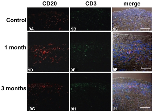 Figure 9 Immunofluorescent micrographs showing colocalization of CD20-positive B lymphocytes and CD3-positive T lymphocytes in the control (A–C) and inflamed lacrimal sac 1 month (D–F) and 3 months (G–I) after Staphylococcus aureus inoculation. In control tissue, a small number of CD20-positive (A, red) and CD3-positive lymphocytes (B, green) were codistributed (C) in the lamina propria. One month after inoculation, numerous CD20-positive (D, red) and CD3-positive lymphocytes (E, green) were coinfiltrated (F) into the lamina propria. Three months after inoculation, the numbers of CD20-positive (G, red) and CD3-positive (H, green) lymphocytes codistributed (I) were decreased compared with 1 month.