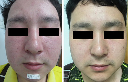 Figure 2 Photos of the patient’s face before (left) and after (right) narrow-band intense pulsed light treatment.
