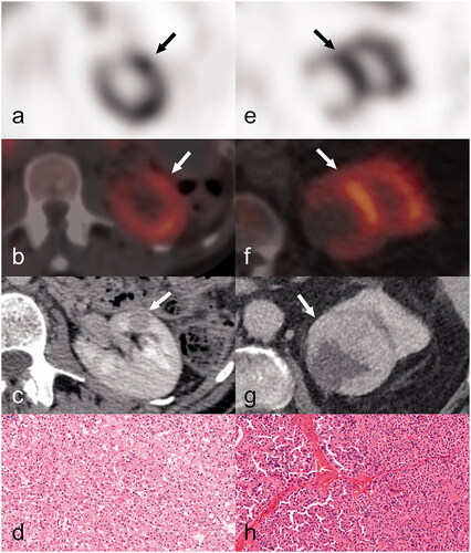 Figure 3. A RO and a HOCT, both positive on 99mTc-Sestamibi SPECT/CT examination. First column, a–d: (case n.9) SPECT axial view (a) of focal 99mTc-Sestamibi uptake in the anterior aspect of the left kidney (indicated by arrow). Anatomic correlation of the previous uptake (c) in the CT study, axial view-venous phase. The axial SPECT/CT fusion image (b) with 99mTc-Sestamibi uptake in the same solid renal neoplasm (12mm in maximum diameter) of the left kidney. This was subsequently diagnosed as HOCT on histopathology (d). Second column, e–h: (case n.13) SPECT axial view (e) displays focal 99mTc-Sestamibi uptake in the upper pole of the left kidney (indicated by arrow). Anatomic correlation of the previous uptake (g) in the CT study, axial view-venous phase. The axial SPECT/CT fusion image (f) with 99mTc-Sestamibi uptake in the same solid renal neoplasm (69 mm in maximum diameter) of the left kidney. This was subsequently diagnosed as RO on histopathology (h).