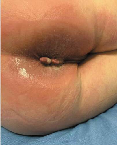 Figure 2. A 30 cm × 30 cm well- defined painful bright pink circular patch centered around the anus