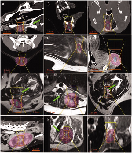Figure 4. Representative examples of canine STS at seven anatomic sites. The PTV was selected as an ellipsoid (purple). A 4 mm diameter treatment cell (green/blue) and the resulting approximate outline of the HIFU beam (yellow) were aligned with the centre of the PTV to optimise the treatment window based on tumour location, and the patient was positioned to allow the greatest unobstructed access to the target. The orange rectangle around the target represents a safety zone in which high temperatures can occur. (A) Head: ≥50% targetable, left maxillary fibrosarcoma with a portion of the tumour invading the infraorbital foramen and left orbit (green arrow); (B) head: <50% targetable, unclassified STS of the rostral right mandible with geographic bone lysis; (C) head: not targetable, unclassified STS within the right nasal cavity; (D) truncal: ≥50% targetable, subcutaneous unclassified STS dorsal to the pelvis; (E) truncal: <50% targetable, unclassified STS medial to the left scapula; (F) appendicular: ≥50% targetable, subcutaneous anaplastic sarcoma of the left distolateral humerus; (G) spine: ≥50% targetable, unclassified STS in the right cervical region with invasion of the spinal canal at C6 (green arrow); (H) spine: <50% targetable, left paraspinal myxosarcoma involving ribs 10, 11 and 12 and invasion of the spinal canal at T10–T11 resulting in extradural spinal cord compression (green arrow); (I) spine: Not targetable, PNST involving the right spinal nerve segment at C4–C5 with extension to the spinal cord (green arrow); (J) abdominal: ≥50% targetable, extramural small intestinal fibrosarcoma; the ellipsoid ROI approximates the PTV, however, additional targets could be selected during therapy to achieve more conformal treatment; (K) axillary: ≥50% targetable, left axillary myxosarcoma partially incorporating the left first rib (green arrow); and (L) axillary: <50% targetable, left axillary PNST.