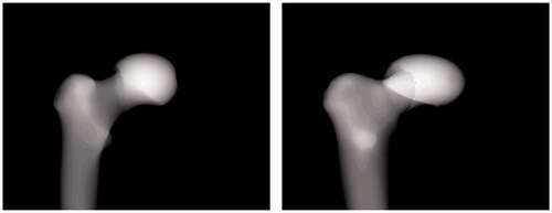 Figure 8. Two poses of DRR images were used to evaluate the scale deformation model. The femoral head of the proximal part is artificially enlarged by 20% in the deformation model.
