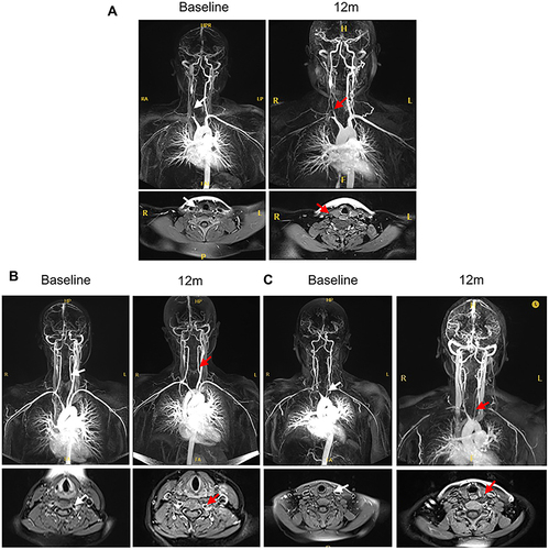 Figure 4 Imaging changes after 12 months of treatment. (A). A 28-year-old female patient with a disease course of 29 months. Before GCs and TOF treatment, the CCL22 levels were 40.83 pg/mL. MRA indicated that the involved vessels exhibited stenosis and occlusion of the right common carotid artery. After 12 months of treatment, the CCL22 levels were 29.22 pg/mL, and MRA suggested that the wall of the right common carotid artery was improved. White arrow: right common carotid artery before treatment, red arrow: right common carotid artery after GCs and TOF treatment. (B). A 31-year-old woman with a disease course of 24 months. The CCL22 levels before and after treatment were 981.05 pg/mL and 1085.58 pg/mL, respectively, and MRA showed thickening of the left vertebral artery was worsened after treatment. White arrow: left vertebral artery before treatment, red arrow: left vertebral artery after GCs and TOF treatment. (C). A 32-year-old woman with a disease course of 30 months. The levels of FGF-2 before and after treatment were 19.41 pg/mL and 133.86 pg/mL, respectively. MRA showed thickening of left common carotid artery wall after treatment. White arrow: left common carotid artery before treatment, red arrow: left common carotid artery after GCs and TOF treatment.