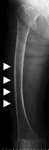 Figure 1. Case 1. The right femur showed lateral cortical thickening with a jagged pattern (arrow).