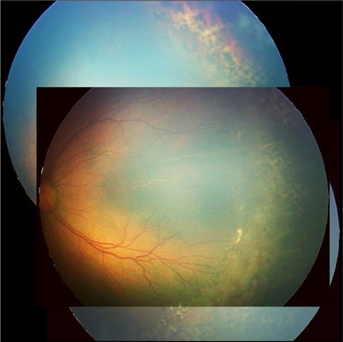 Figure 2 Fundus photograph taken 8 weeks after pattern scan laser system PASCAL® Streamline (Topcon Medical Laser Systems, Santa Clara, CA, USA) laser photocoagulation.