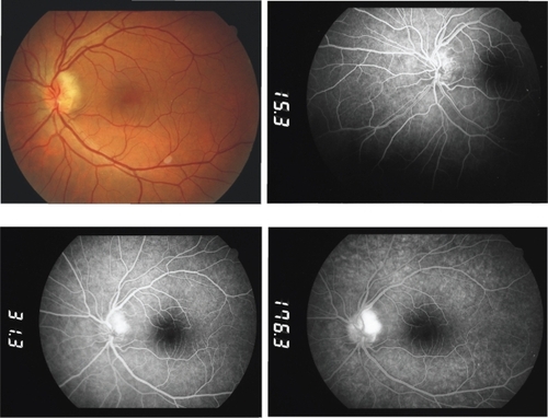 Figure 1 Case 1 on presentation. Color fundus photo and early, intermediate, and late fluorescein angiograms depicting optic disc edema and leakage at late stages.
