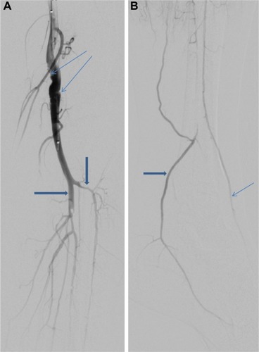 Figure 6 Digital subtraction angiographic (DSA) images following lytic therapy.