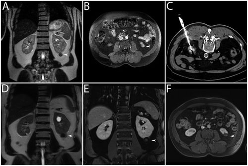 Figure 1. Clinical example. Bipolar RF ablation was performed in a T1a renal cell carcinoma. (A, B) Dynamic MRI (T2w coronal image and T1w transverse image) for the diagnosis of an exophytic contrast-enhancing renal cell carcinoma in the lower segment of the left kidney (white arrowheads). (C) CT (transverse image) for documentation of correct positioning of the applicator (active tip length of 30 mm) – note the tip of the applicator was positioned slightly beyond the tumour margin. (D, E, F) Dynamic MRI (T2w coronal image, T1w transverse image and T1w coronal image) 22 months after bipolar RF ablation without evidence of local recurrence – note signs of complete tumour destruction with fat tissue necrosis and lack of suspect contrast-enhancement (white arrowheads).