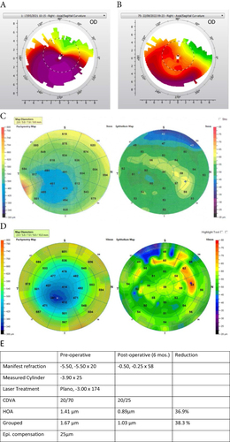 Figure 3 (A–E) Case 3: 20 year old female: (A) Pre-op topography, (B) Post-op topography, (C) Pre-op OCT pachymetry and epithelial thickness map, (D) Post-op OCT pachymetry and epithelial thickness map, (E) patient data.