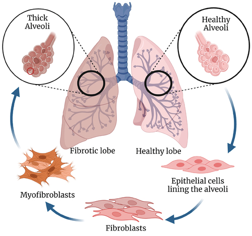 Figure 1. Pathophysiology of pulmonary fibrosis. Right healthy lung (light pink) in which alveoli is lined with epithelial cells which upon stimulation from inflammation or apoptosis recruits fibroblasts. These fibroblasts undergo activation and differentiation to myofibroblasts that results in the synthesis of extracellular matrix and airway remodeling to ultimately cause scarred tissue or thickened alveoli walls shown in left lung with fibrosis (dark pink). Created with Biorender.com.
