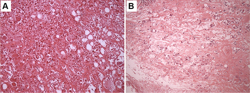 Figure 4 H&E Histomicrographs. (A) (200X) shows tumor ghost cells (devoid of nuclei with area demonstrating infiltrating lymphocytes). (B) (100X) shows extensive fibrosis and tumor cells undergoing apoptosis with occasional infiltrating lymphocytes. No obvious viable tumor cells are seen in both H&E slides.