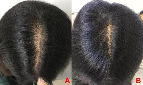 Figure 1 Head hair at initial diagnosis (A) and 3 months later (B).
