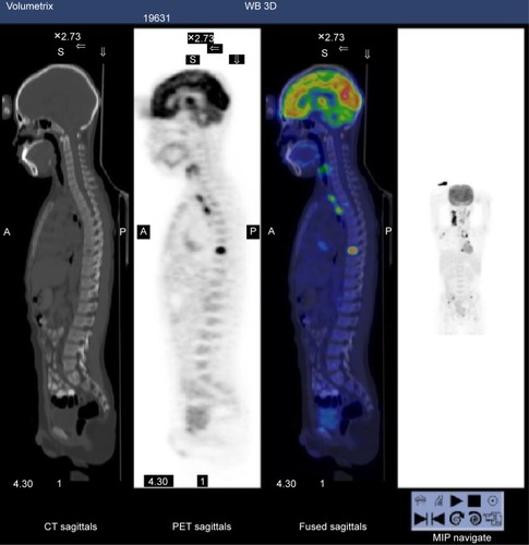 Figure 1 PET-CT of the patient.