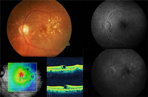 Figure 1 Subject 3: Baseline visit. A 67-year-old male complained of blurred vision on his left eye. Retinography demonstrates soft confluent drusen within the macular area (top left). Best-corrected visual acuity was 20/50. Optical coherence tomography revealed a drusenoid pigment epithelial detachment, and microcystic hyporreflective spaces within the neurosensory retina and an elevated retinal map (bottom left). Fluorescein angiography did not show any choroidal neovascularization associated (top and bottom right).