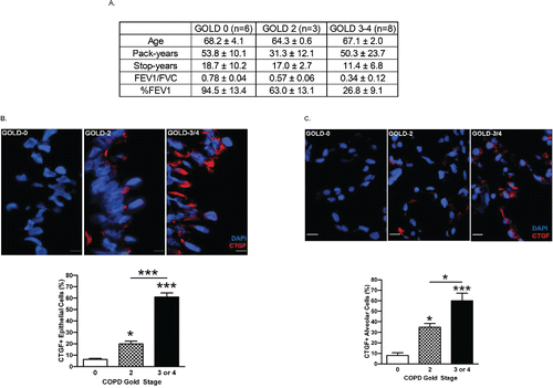 Figure 1. CTGF expression is increased in lung epithelial cells of ex-smokers with increasing COPD severity. (A) The demographic and clinical data for ex-smokers based on the clinical stage of COPD (GOLD 0: n = 6, GOLD 2: n = 3, GOLD 3–4: n = 8) analyzed in this study (**p < 0.01). GOLD: The Global Initiative for Chronic Obstructive Lung Disease; FEV1: forced expiratory volume in 1 second; FVC: forced vital capacity % FEV1: % predicted value of FEV1. (B) Analysis of CTGF expression in airway epithelium of ex-smokers with COPD. Representative micrographs showing CTGF-immunopositive cells (red) in airway epithelial cells from ex-smokers with COPD at GOLD stage 0, 2 and 3–4. Nuclei were counterstained with DAPI (blue) (scale bar, 10 μm). Quantitative analysis of CTGF-positive airway cells in the three clinical groups are also shown (*p < 0.05; ***p < 0.001). (C) Analysis of CTGF expression in alveolar cells of ex-smokers with COPD. Representative micrographs showing CTGF-immunopositive cells (red) in alveolar cells from ex-smokers with COPD as mentioned above. Nuclei were counterstained with DAPI (blue) (scale bar, 10 μm). Quantitative analysis of CTGF-positive airway cells in the three clinical groups are also shown (*p < 0.05; ***p < 0.001).