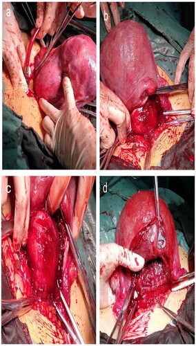 Figure 2. Enucleation of intramural fibroids in the uterine posterior wall through trans-endometrial approach. (a) Rapid exploration of the size, number and location of fibroids after delivery of the fetus and placenta. (b-c) Squeeze the fibroid in the direction of the uterine cavity and make an incision in the most prominent part of the endometrium to reach the pseudocapsule of fibroids. (d) After complete removal of the uterine fibroid, the cavity was closed with 1-0 vicryl continuous sutures.