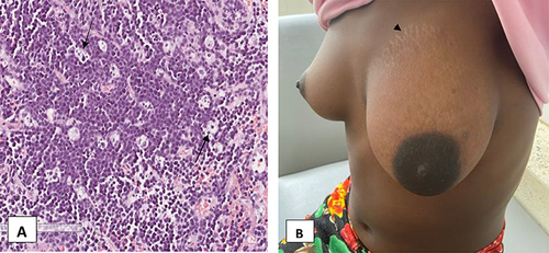 Figure 2 (A) (x20) shows an H&E stained section of the tumor with medium-sized cells, a high N: C ratio, and numerous tingible body macrophages (black arrows) giving it a characteristic starry sky. (B) shows a reduction in the size of the breast a week after her first cycle of chemotherapy with striae seen on the upper border of the breast (black arrowhead).