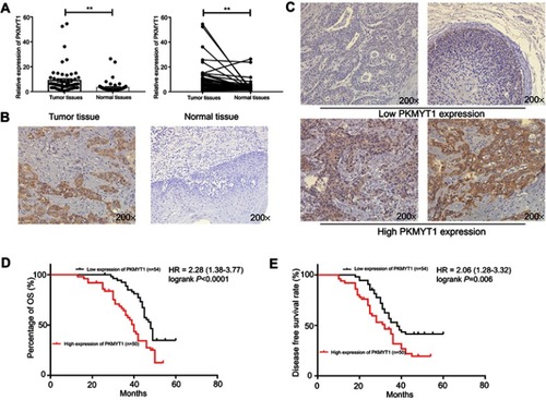 Figure 1 PKMYT1 is up-regulated and associated with prognosis in patients with ESCC. (A) The RT-qPCR results indicated that PKMYT1 is up-regulated in ESCC tumor tissues compared with normal tissues. (B) The IHC results indicated PKMYT1 was up-regulated in ESCC tumor tissues than normal adjacent tissues. (C) According to the scores and staining of IHC, IHC score (Left upper:0; Right upper:2; Left lower:8; Right lower:12), we divided these patients to two groups. (D, E) High expression of PKMYT1 related to lower overall survival time and disease-free survival time. **P<0.01.Abbreviations: PKMYT1, protein kinase, membrane associated tyrosine/threonine; ESCC, esophageal squamous cell carcinoma; IHC, immunohistochemistry; OS, overall survival.