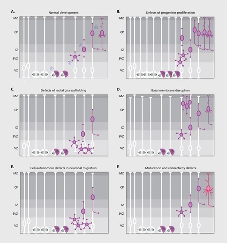 Figure 1. (Opposite). Schematic representation of cortical development in normal and pathological conditions. (A) During development, radial glia cells (in white) divide symmetrically to expand the pool of progenitor cells and asymmetrically to produce postmitotic neurons (1). Neurons acquire a multipolar morphology and pause in the SVZ (2), before becoming bipolar and starting to migrate along radial glia fibers (3). Once they reach their final position in the CP, neurons mature and establish precise input and output connections (4). Genetic or environmental factors can induce defects at each step of this process. (B) Abnormal progenitor proliferation can be caused by a defective timing of symmetric-to-asymmetric division switch or by defects in the orientation of the mitotic spindle. These lead to the production of an aberrant number of neurons (eg, an increase in neuronal production, as depicted in the figure), thus often causing megalencephaly or microcephaly. (C) Alterations in radial glia scaffold (eg, defective radial glia anchoring to the apical membrane) impair neuronal proliferation and/or migration and can lead to the accumulation of neurons in the VZ and to the formation of nodular heterotopia. (D) As opposite, defective formation of the basal membrane leads to neuronal overmigration and accumulation on the pial surface, with the formation of cobblestone malformations. (E) Delayed or aberrant neuronal migration can arise from cell-autonomous defects (ie, neurons are intrinsically unable to migrate properly to the CP) and lead to cortical layering alterations as subcortical band heterotopia. (F) Even when early defects in neurogenesis are caught up and do not lead to macroscopic alterations of brain structure or layering, subtler defects in neurite extension, synaptogenesis, short-term and long-term connectivity with target cells can also be detected. MZ: marginal zone; CP: cortical plate; IZ: intermediate zone; SVZ: subventricular zone; VZ: ventricular zone.