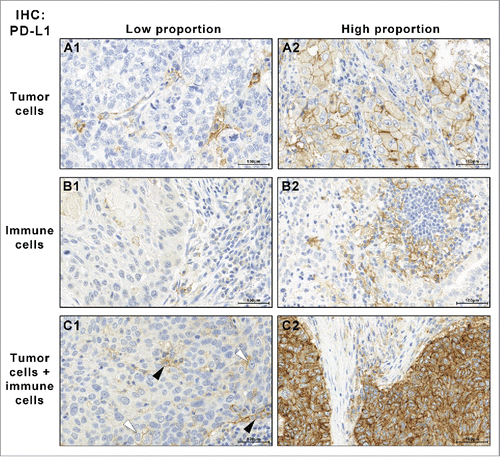 Figure 1. PD-L1 IHC-staining patterns: expression was noticed in the tumor cells (A), in tumor-associated immune cells (B) or in both cell types (C; white arrow head: PD-L1-positive tumor cells, black arrow heads: PD-L1-positive immune cells). The proportion of positive cells varied with some cases showing few positive cells (A1–C1) while others showed mostly positive cells (A2–C2) (IHC PD-L1, Ab 5H1, 560x).