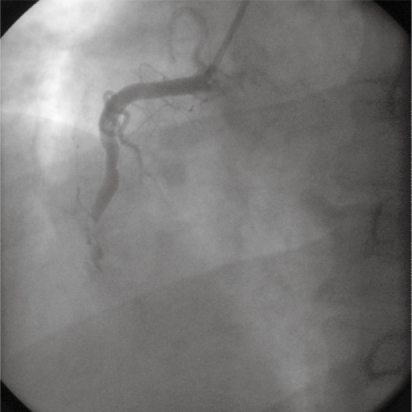 Figure 3 A left anterior oblique view of the right coronary system, demonstrating a total occlusion of the mid right coronary artery with thrombus.