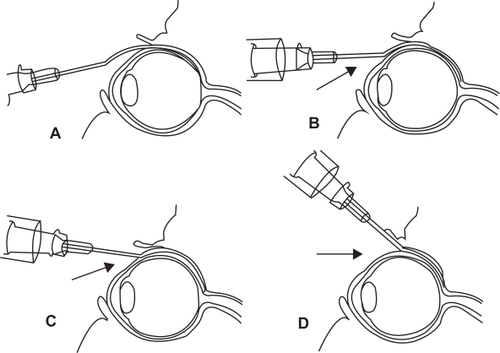 Figure 5 Technique of posterior juxtascleral depot injection involves the introduction of cannula into the subconjunctival/subtenon’s space and subsequent advancement behind and adjacent to globe.