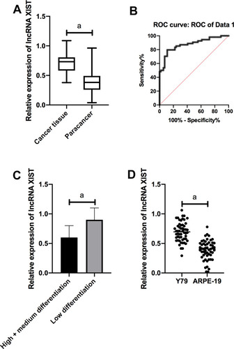 Figure 1 Expression of lncRNA XIST in Rb. (A) XIST was remarkably up-regulated in Rb tissues compared with normal tissues adjacent to the cancer. (B) ROC analysis showed that the AUC of XIST was over 0.8. (C) XIST was notably lower in high/medium differentiated tissues than in low differentiated tissues. (D) Compared with human normal retinal epithelial cells ARPE-19, XIST was noticeably increased in Rb cell line Y79.