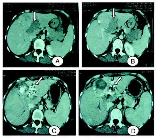 Figure 1. A 38 y old female patient. (A and B) Computer tomography shows tumor thrombus in left branch of portal vein. (C and D) Computer tomography shows that tumor thrombus was largely lessened for the same patient, and the left branch was more patency than before.