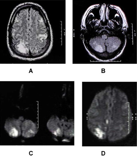 Fig. 1.  MRI of the brain 12 hours after concentrated hydrogen peroxide ingestion demonstrating hyperintensities in (A) the right occipital cortex, left central sulcus and bilateral frontal lobes and in bilateral cerebellar hemispheres (B) on FLAIR imaging, areas of restricted diffusion in the bilateral cerebellar hemispheres (C) and in the right occipital cortex (D).