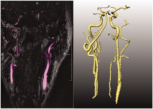 Figure 2. An example result of the graph-cut vessel segmentation algorithm. Pre-processed coronal slice of the MRA image of a patient with vessels segmentation color overlay in purple (left), and the skeletonization of the arterial vessel tree (right).