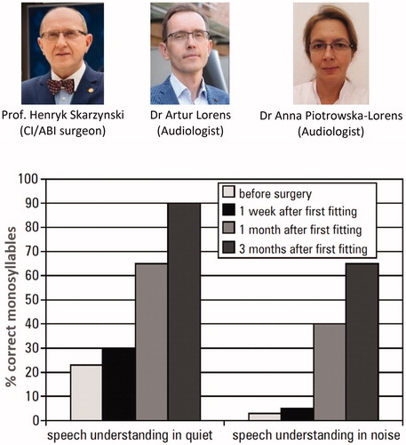 Figure 7. Clinicians from the Warsaw Institute of Physiology and Pathology of Hearing, Poland, treated the first Polish EAS-indicated patient with MED-EL device. Results of monosyllabic speech understanding after CI in quiet surroundings and noise [Citation6].