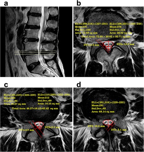 Figure 5. The relationship between a positive SedSign and a change in the CSA of the dural sac at the level of stenosis. a: A sagittal T2-weighted image of L4/5 shows compression of the dural sac because of substantial narrowing in the third MRI scan. b: The first transverse layer of level L4/5, at which point the dural sac was lightly compressed, and there was minimal tendency of the neve roots or cauda equina to move ventrally or toward the center of the spinal canal. A suggestion of a positive SedSign was observed, although not definitively. c: The second transverse layer of level L4/5 OR MR image, at which point the narrowing of the dural sac was increased, the nerve roots were shifted substantially, and a positive SedSign was present. d: The third transverse layer of level L4/5 showed the greatest stenosis. Because of the narrowing of the canal, the nerves were ‘‘squashed’’ and therefore present on both sides of the equator, such that a positive SedSign was apparent.