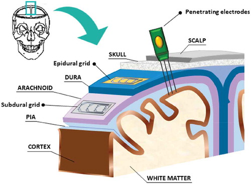 Figure 2. A sketch showing the parts of head where grids can be placed to collect signals from the cortex: subdural devices, epidural devices and penetrating electrodes. Non-invasive electrodes have not been taken into account in this scheme.