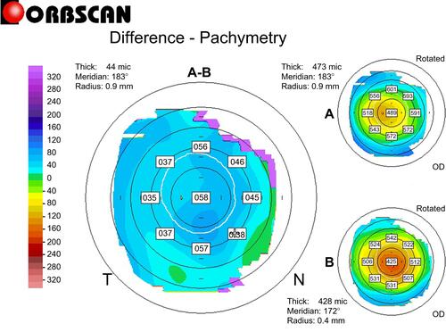 Figure 6 Differential pachymetric map by Orbscan II (Bausch & Lomb, Bridgewater, NJ, USA) between pre- and post-E-LAK-SCAP in case 1.