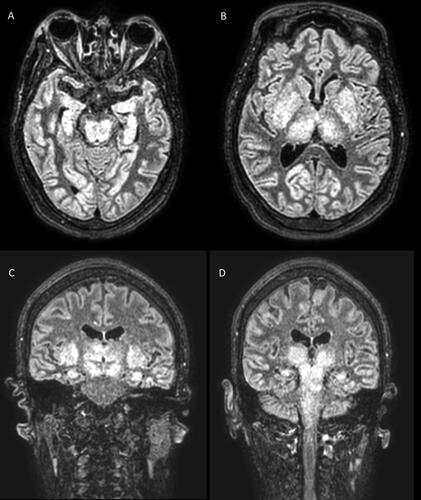 Figure 1. Brain MRI axial imaging slides showing diffuse cortical T2-weighted hyperintensities, symmetrical T2-weighted hyperintensities in the midbrain and hippocampi (panel A), basal nuclei, and thalami (panel B). MRI coronal imaging slides show basal ganglia, thalami, and hippocampi involvement (panel C) with extension into midbrain, pons, and medulla (panel D).