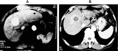 Figure 1. Imaging examination of tumours before and after surgery. (A) Before surgery; (B) after surgery.