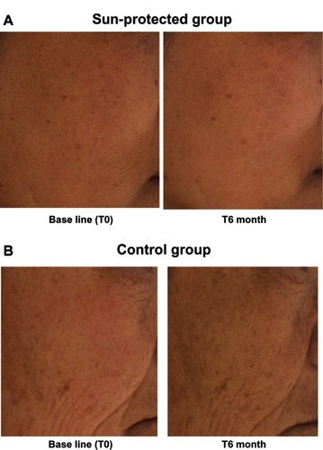 Figure 4 (A) Chromasphere picture for efficacy demonstration with photoprotection. (B) Picture for efficacy demonstration without photoprotection.