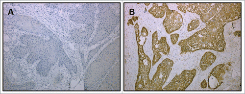 Figure 2. PKM2 expression in human OSCC samples measured by immunohistochemical staining. (A) Representative low expression of PKM2 in a primary human OSCC (×200); (B) Representative high expression of PKM2 in a primary human OSCC (×200). Nuclei are counterstained with hematoxylin.
