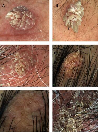 Figure 2 Different patterns of common warts under the dermoscope. (A) finger like projections. (B) Finger like projections with bleeding spots on it. (C) papillomatous lesion with bleeding spots surrounded by whitish known as frogspawn appearance. (D) big number of little fat finger like projections. (E) papillomatous growth accompanied with hairpin-like vessel (black arrow). (F) papillomatous lesion with bleeding spots surrounded by whitish known as frogspawn appearance.