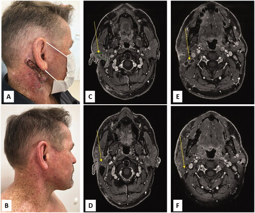 Figure 1. Tumor response of advanced cutaneous squamous cell carcinoma to pembrolizumab with clinical photography (A, B) and cervical MRI images (C-F): Right ulcerative parotid mass, severe helioderma (A) and right surrounding mastoid and parotid mass (C), associated with multiple cervical necrotic lymph nodes (E) before treatment. Major clinical response with complete healing of the skin (B), decrease of the parotid mass (D) and disappearance of several cervical necrotic lymph nodes (F), 3 months after pembrolizumab introduction.