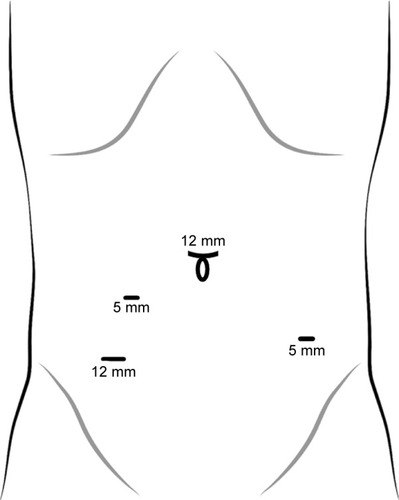 Figure 3 Trocar placement and the size of the trocars.
