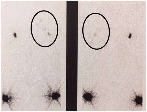 Figure 7. Outcome after 23 years showing transport of lymph from both arms in a lymphoscintigraphy. Ovals encircle the flow in the left side where lymph is transported via the grafts to of the neck. Left, frontal view; right, dorsal view.