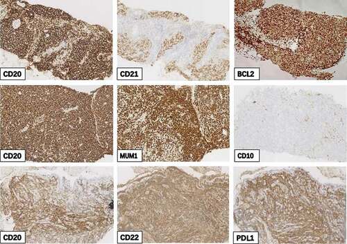 Figure 2. Immunohistochemical (IHC) staining of three tissue biopsy samples. IHC staining of CD20 (a), CD21 (b), and BCL2 (c) in the first tissue biopsy samples. Positive IHC staining of CD20 (d) and MUM-1 (e) and negative staining of CD10 (f) in the second tissue biopsy samples. Positive staining of CD20 (g), CD22 (h), and PD-L1 (i) in the third tissue biopsy samples. (original magnification, 200×)