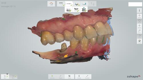 Figure 10 Final digital impression with Trios 3shape scanner, right bite.