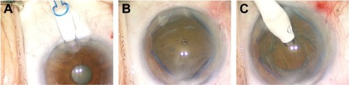 Figure 1 Mechanical dilation with ring expander.