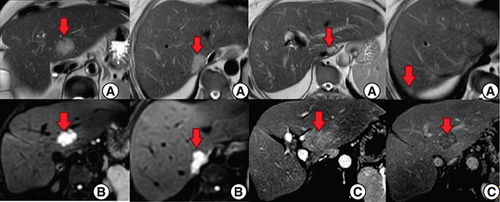 Figure 2. Hepatic MRI – axial sections.(A & B) Hepatic lesions (red arrows) in hypersignal T2 and diffusion respectively. (C) Post-contrast images show enhancement in the arterial phase with a wash out in the portal and late phases.