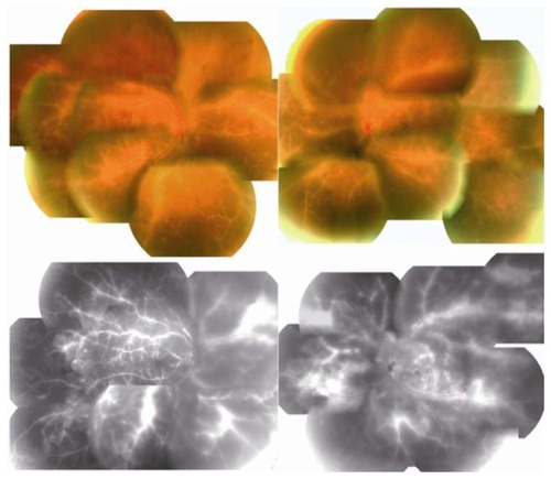 Figure 1 Fundus photographs and fluorescein angiograms at initial examination showing bilateral diffuse perivascular sheathing and retinal edema with intraretinal hemorrhages (upper panel).