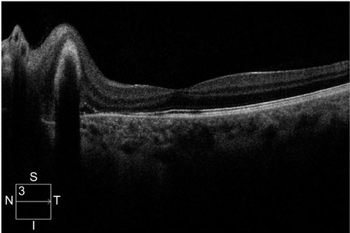 Figure 2 Spectral-domain optical coherence tomography.
